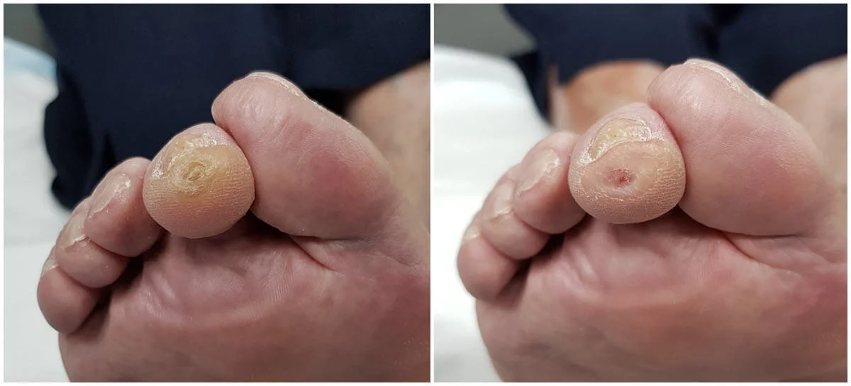 Apical corn before & after.jpg
