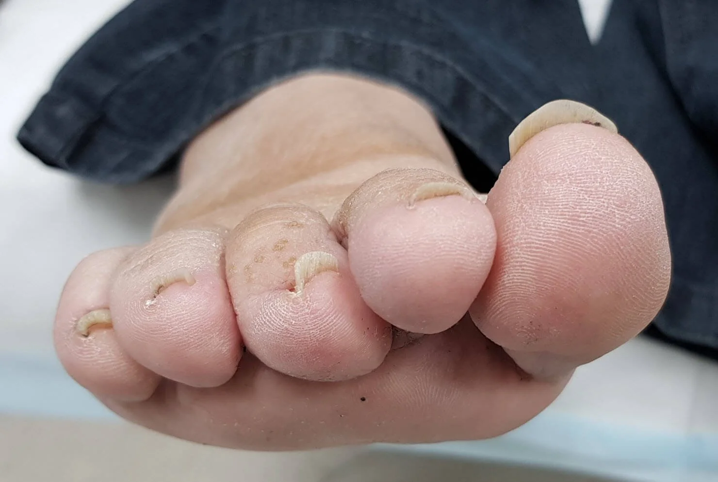 Hard to cut toenails.jpg