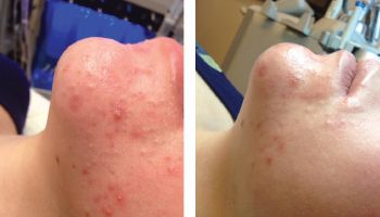 Acne-Treatment.jpg