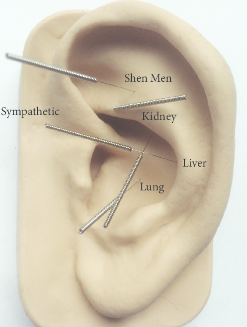 Auricular Acupuncture Chart Download