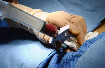 Figure 6: Bone marrow harvest