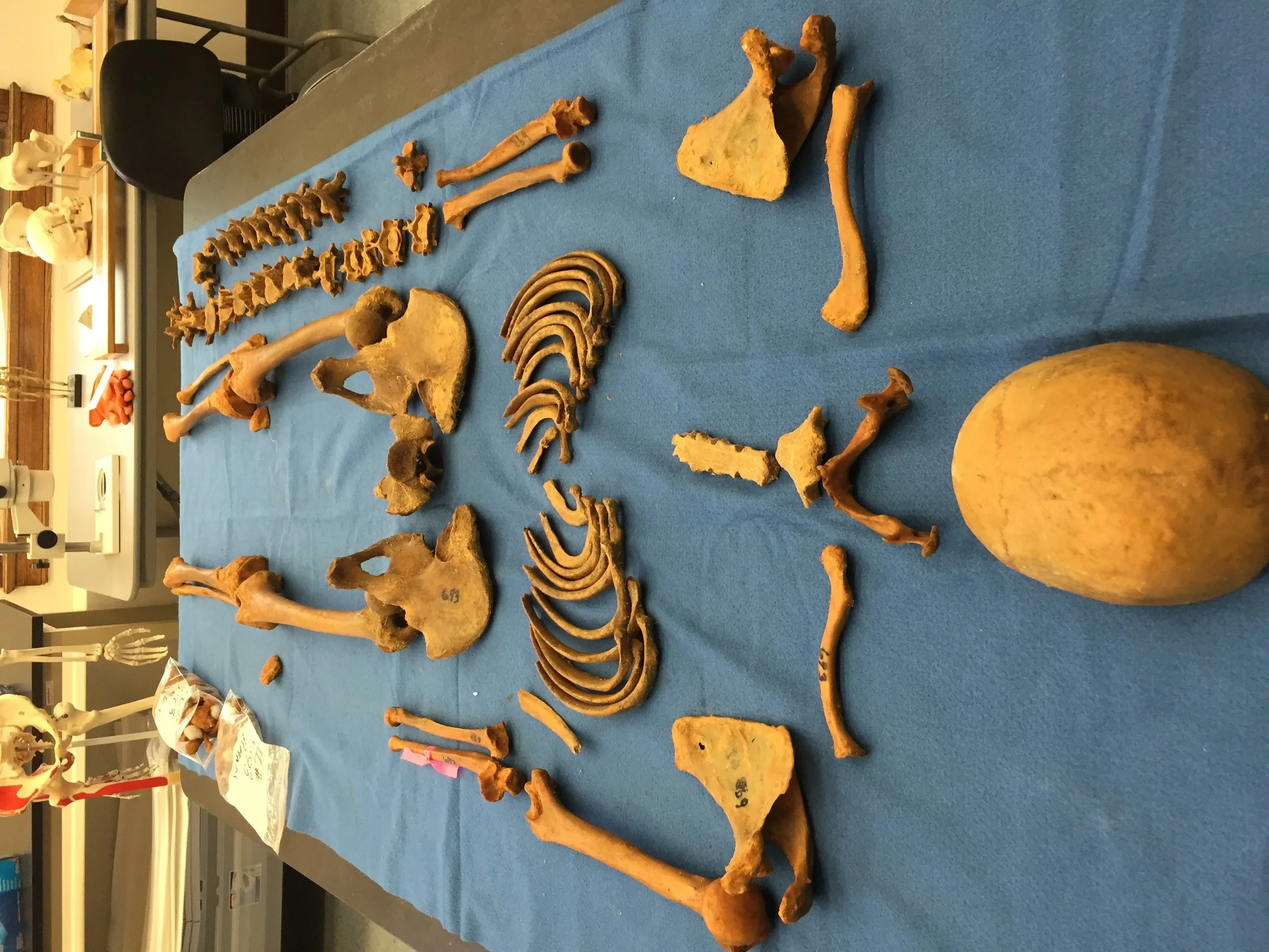 Figure 8: Defleshed Cadaver #693