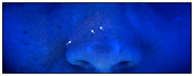 Figure 1: Imaging auto-fluorescent P. acnes in human facial skin. Wood’s light examination, most notably on the nose and the forehead.