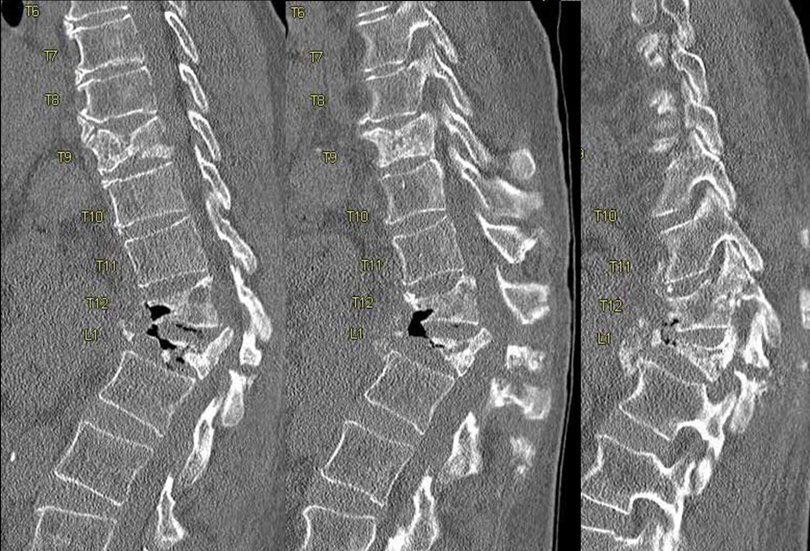 Preop CT Scan with Sever fractures of T12 and L1