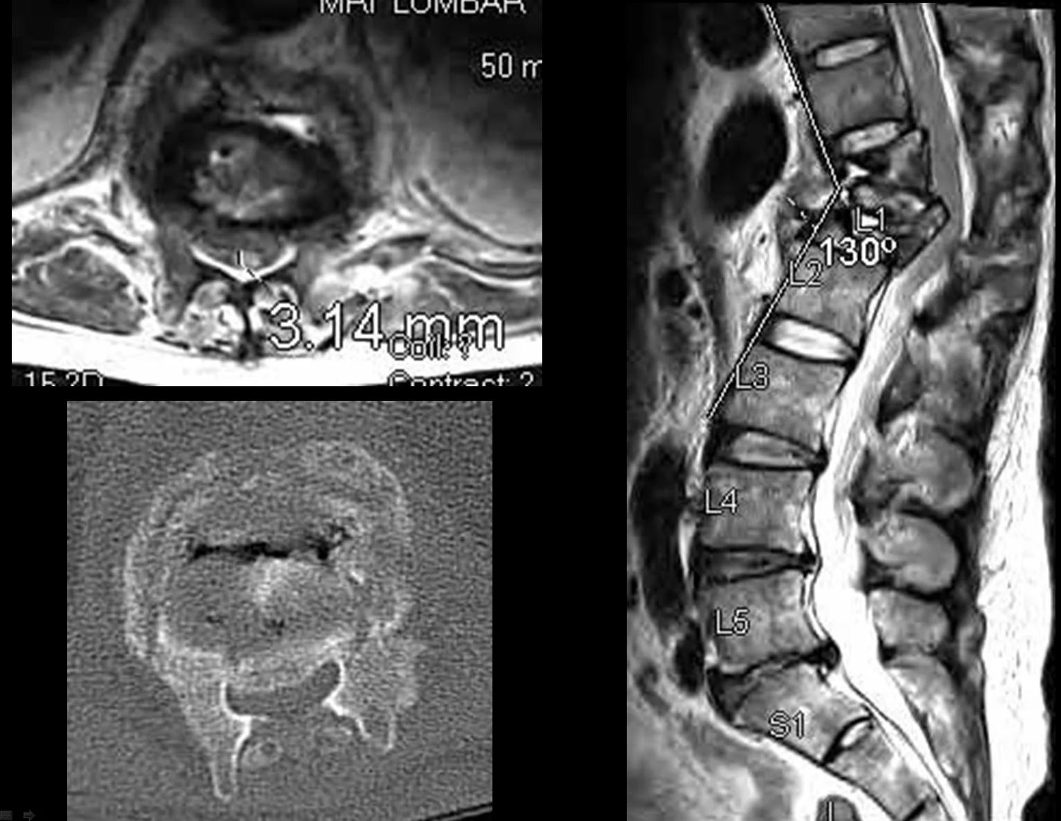 Preop MRI which shows severe pressure on spinal cord