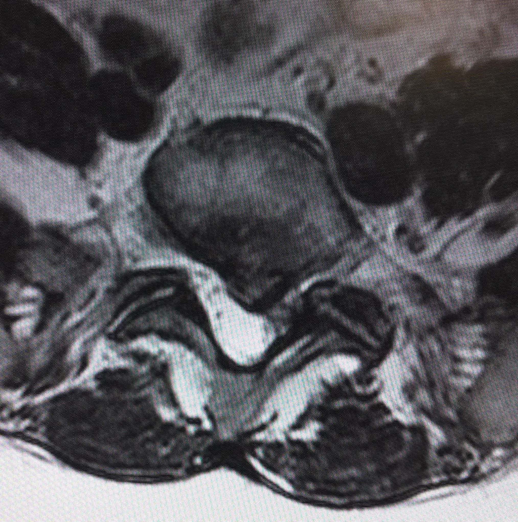 preop mri ax 1.jpg