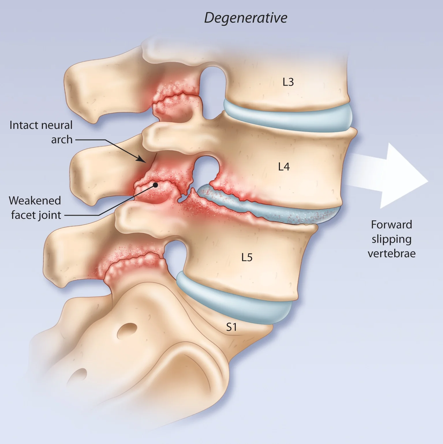 0604spondylolisthesis_vert1.jpg