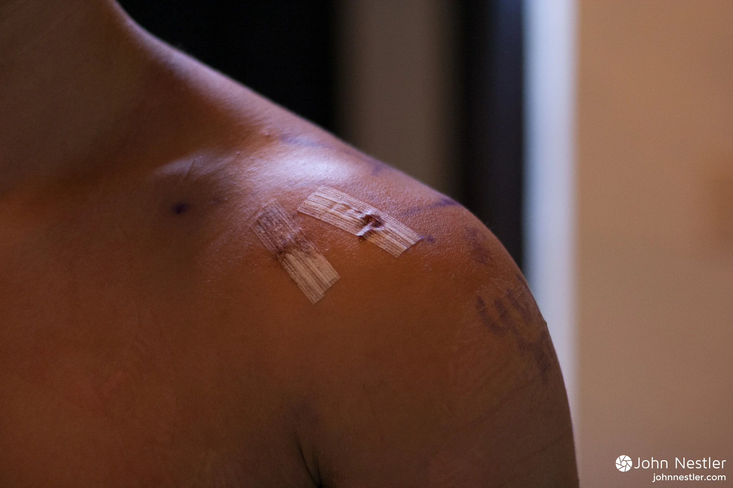 Shoulder Injuries: Bent Shaft vs. Straight Shaft Paddles