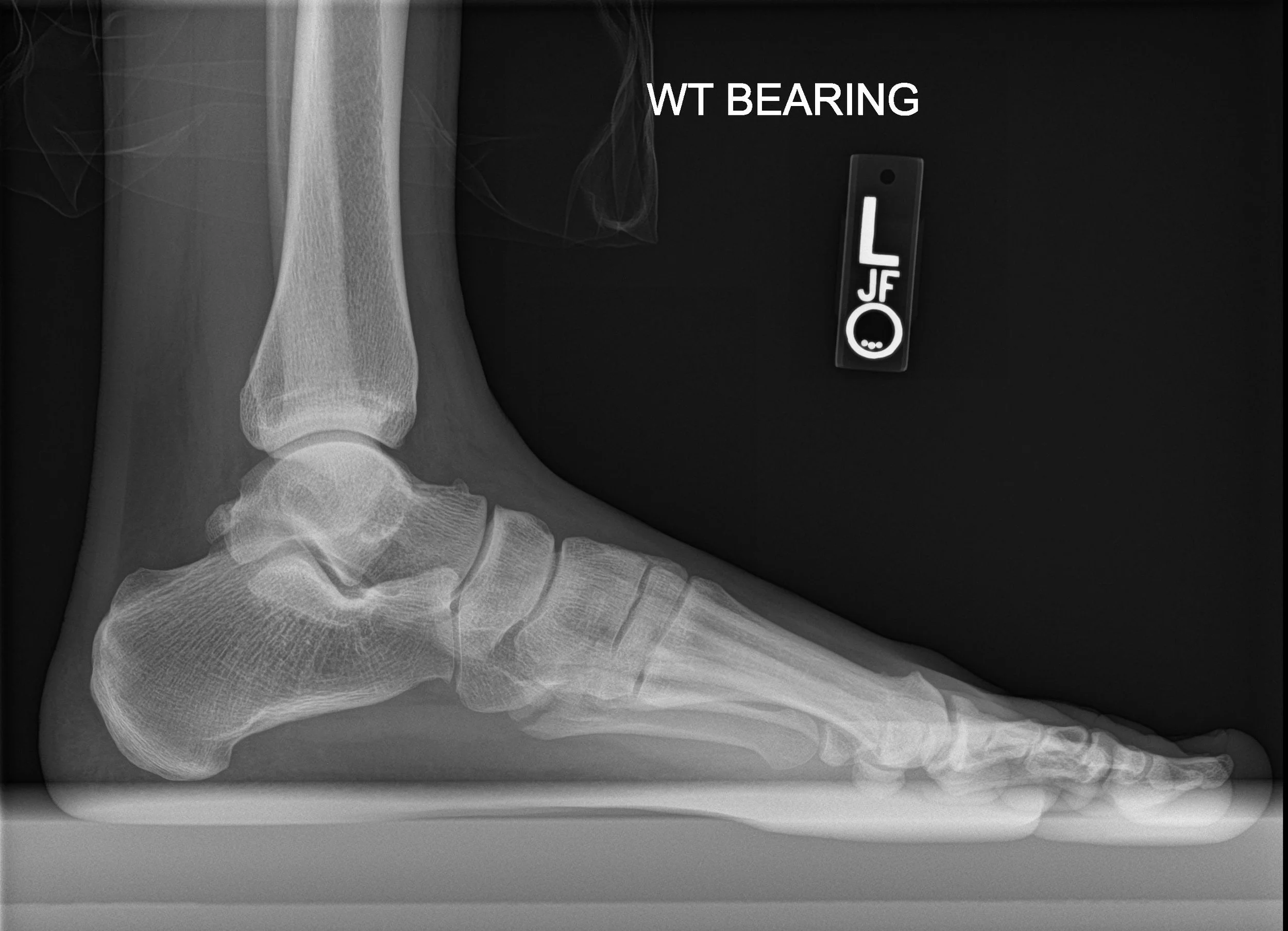 Are Vitamin D and Calcium Supplements Beneficial for Fracture Healing?