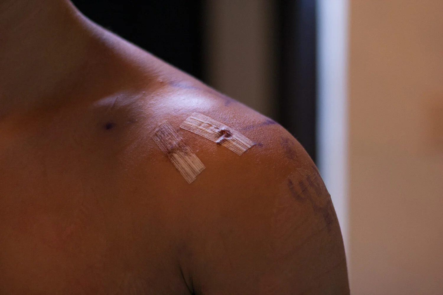 Labrum Repair Shoulder Surgery – EMVQOE