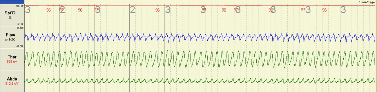 Normal Sleep at Sea Level This image shows me breathing normally whilst sleeping at sea level. The red line shows oxygen levels in the blood, the blue line is airflow through the nose, and the green lines show breathing effort as represented by movement of the chest and abdomen.