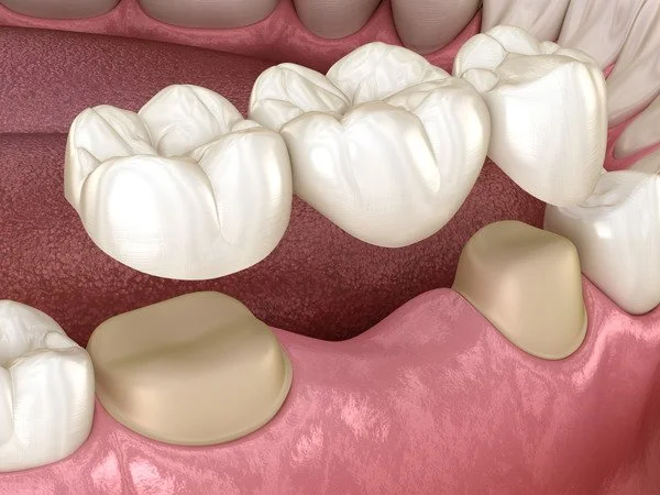 Crown and bridge - Enlighten Dental