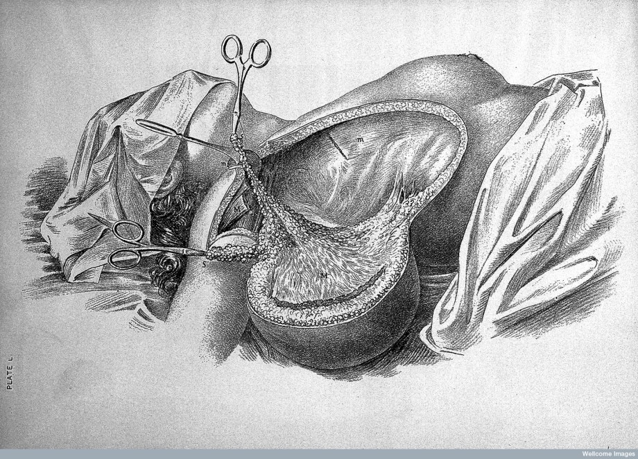 Cancer of the Breast, Field Operation, just before the final cut (Wellcome Library).