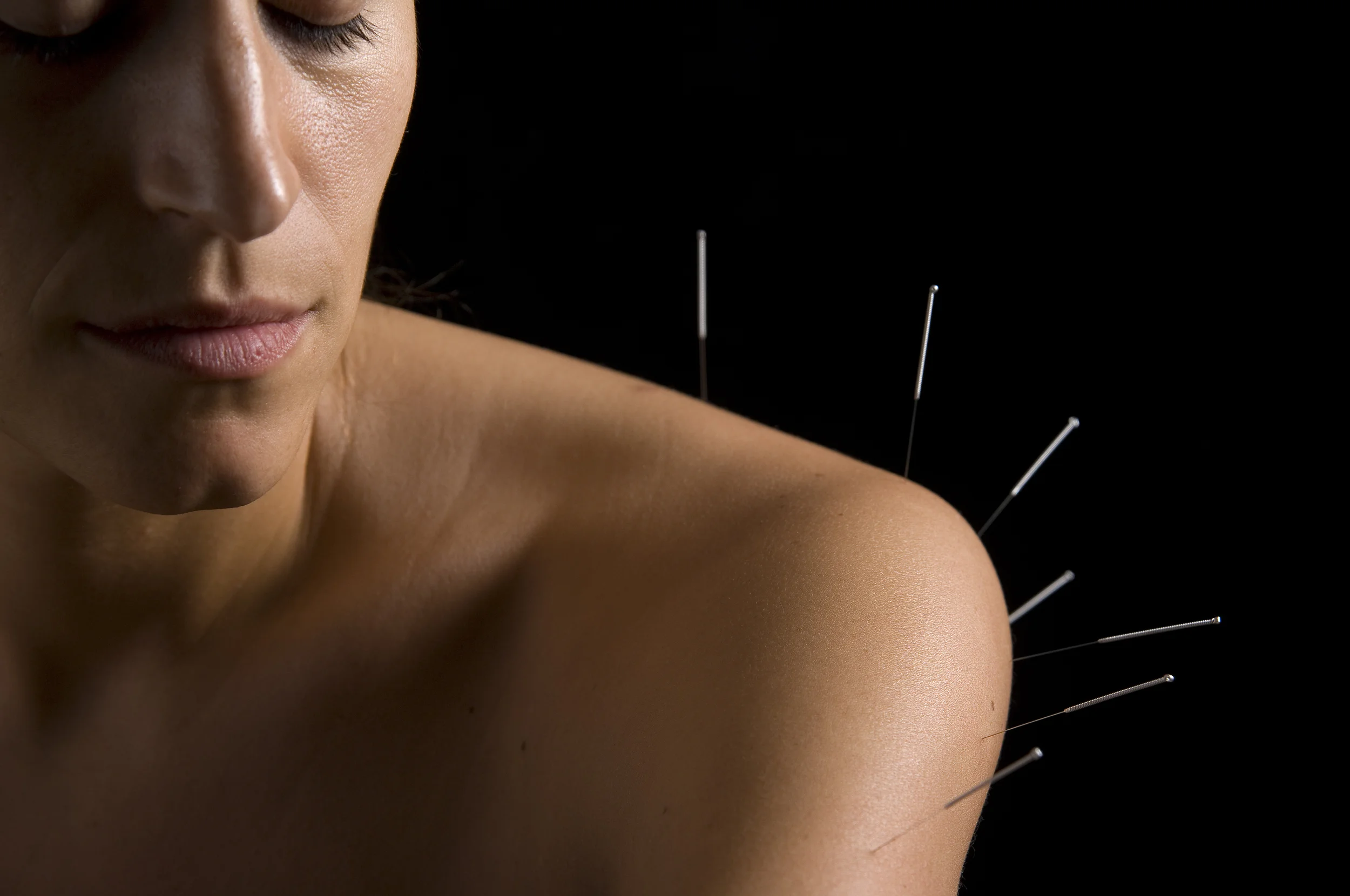 acupuncture-for-pain.jpg