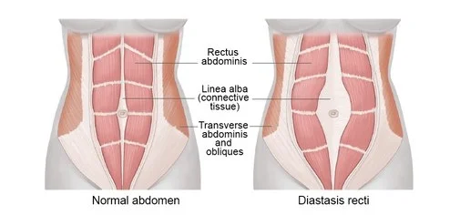 diastsis recti.jpg
