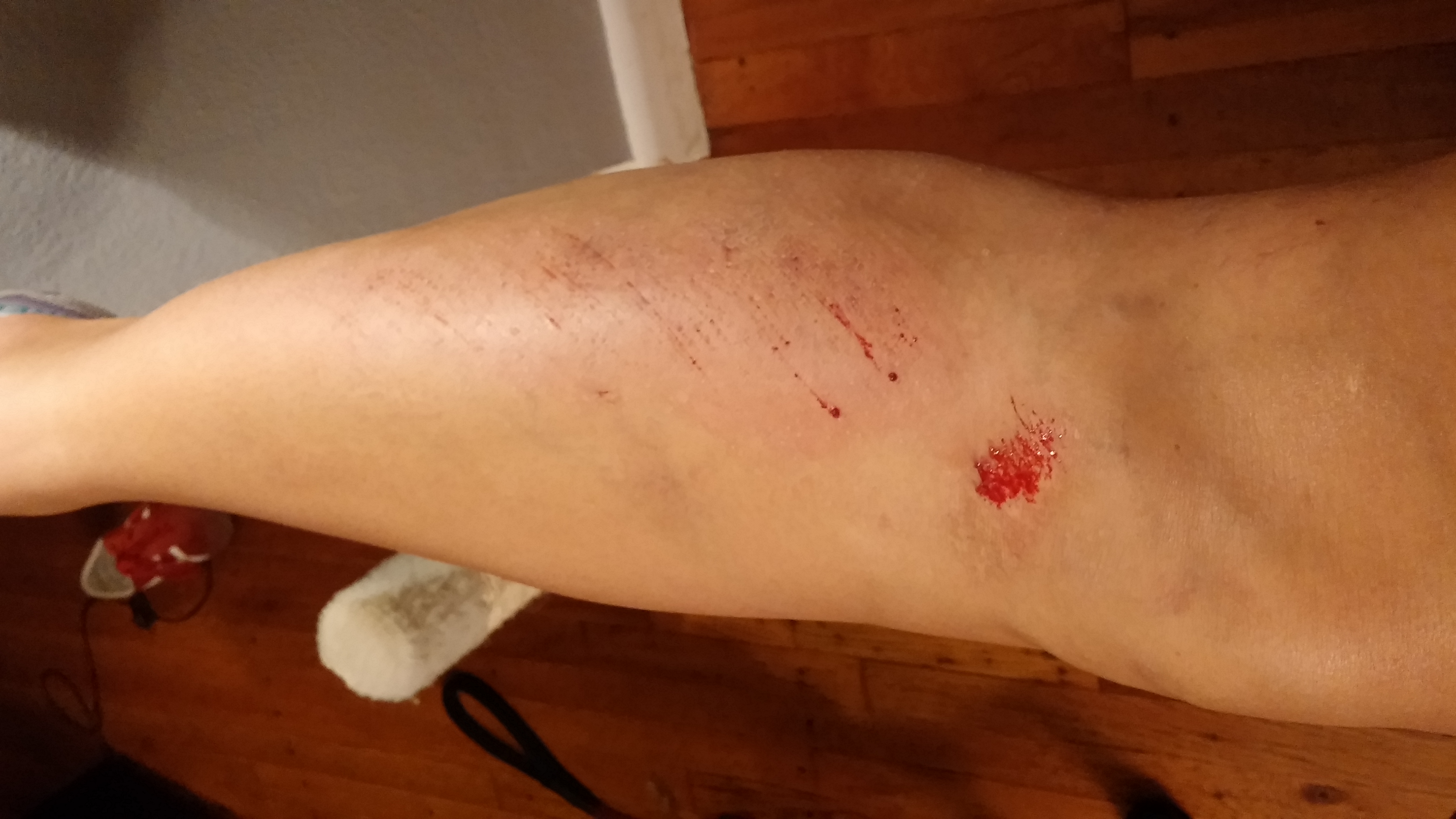 Hey, look! The new scar will be on top of the old scar! Sweet! Also, I had to delete the first photo I took because the dog was trying to lick the blood off my leg. 