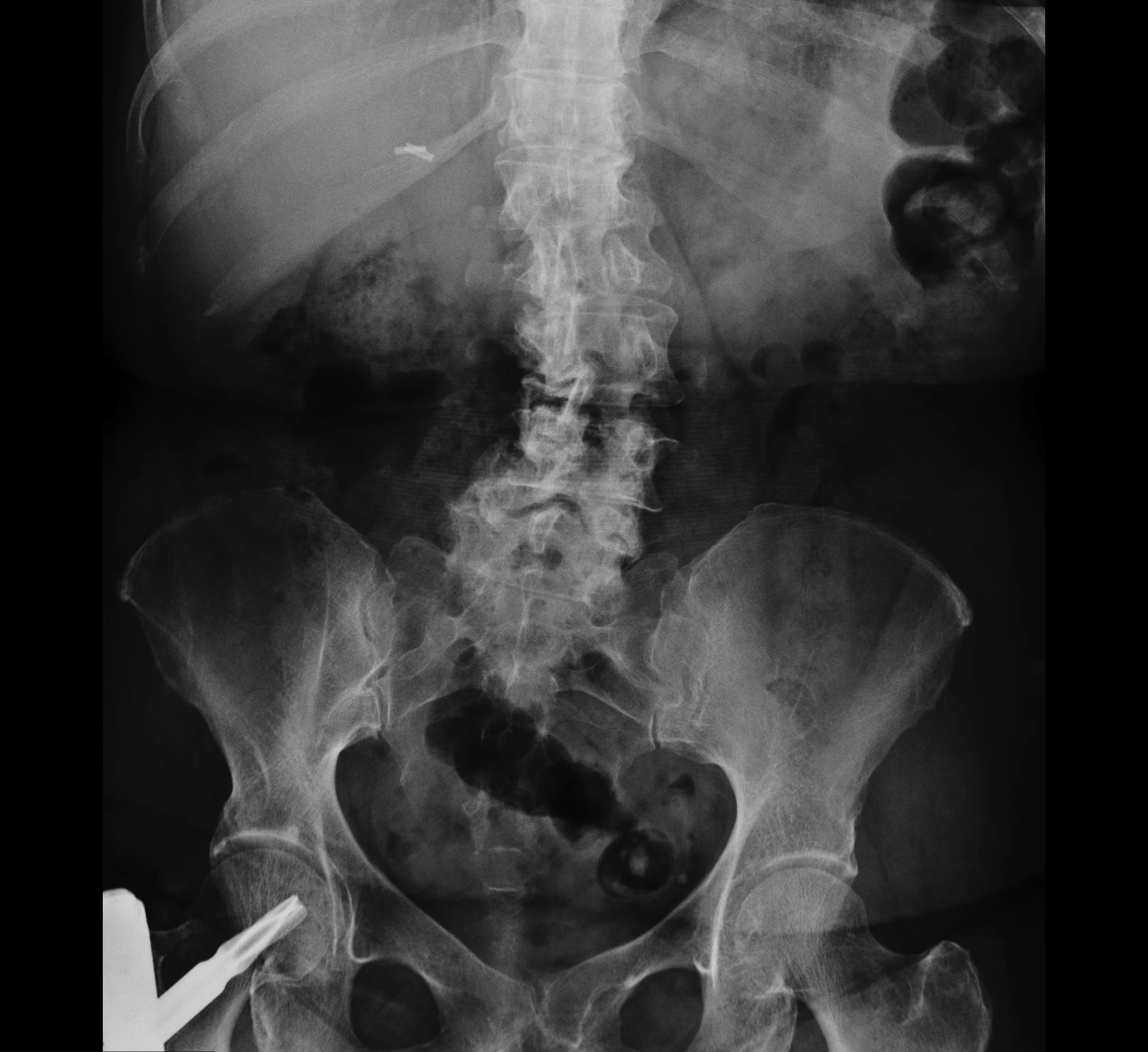 Kerry's healed spine and femur