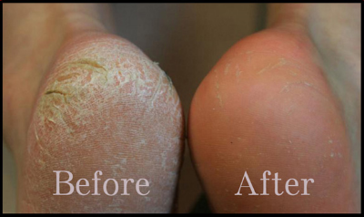 dead skin feet peel