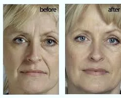 Restylane (1).jpeg
