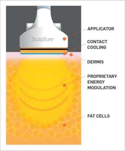 Sculpsure2.jpg