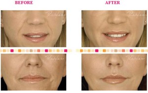 Restylane Silk in the lips