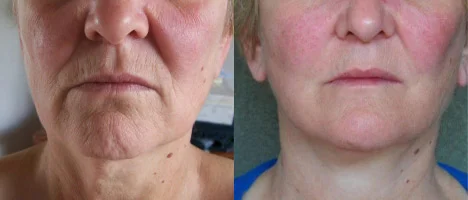 Ultherapy around the mouth