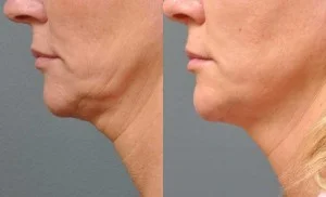 Ultherapy of the lower face