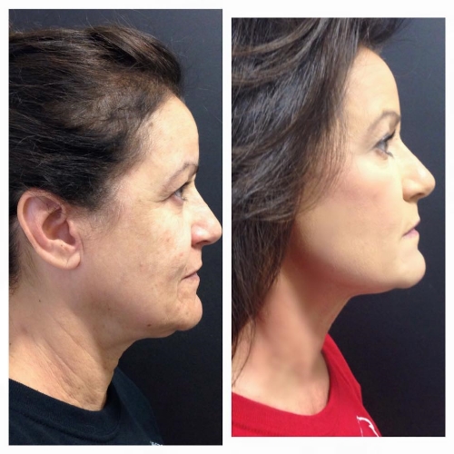 Full face Ultherapy