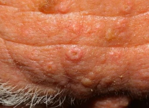 SebaceousHyperplasia.jpg