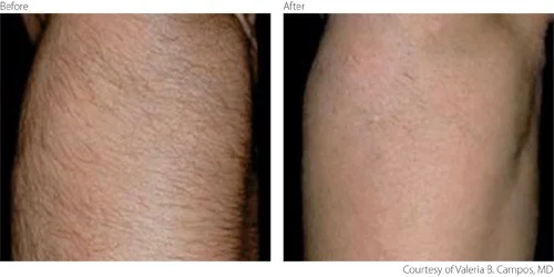 hairremoval1.jpg