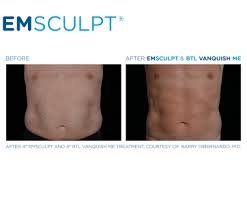 Emsculpt5.jpg