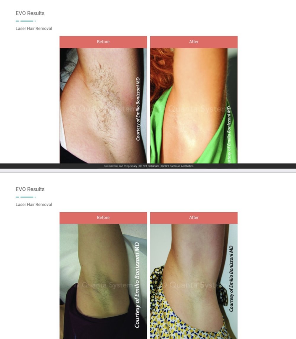 Laser Hair Removal | Sei Bella Med Spa Laser Hair Removal | Sei Bella Med Spa