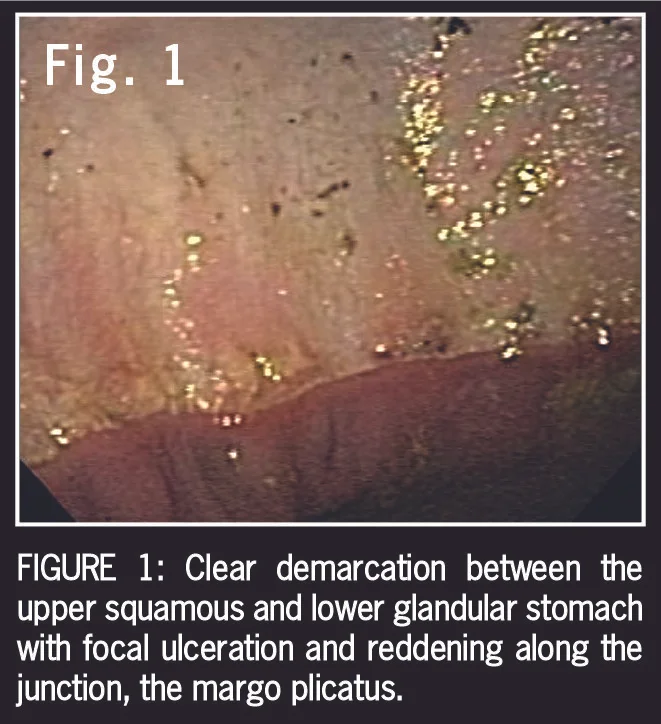 Ulcer FIG 1-03.jpg