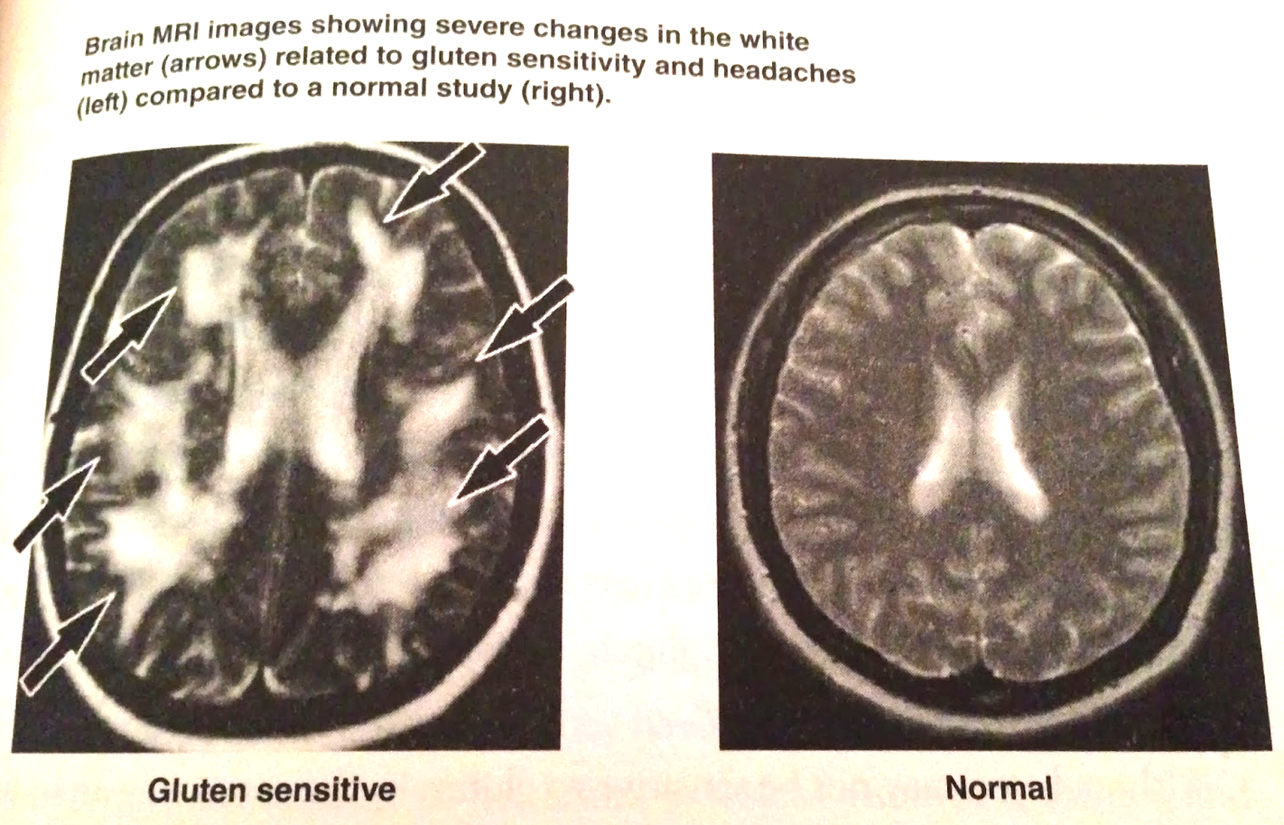 Pg 59 of 'Grain Brain'