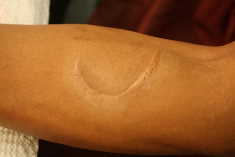 Pros-aide transfer scar