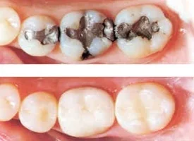 Fillings can be made of multiple materials usually either metallic or composite. We predominantly use composite material although we can also offer metallic fillings.