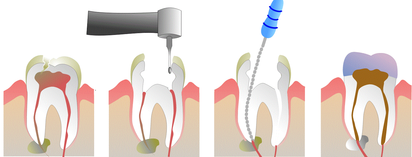 Root canal therapy literally requires getting to the root of your pain where the infection is and treating it then filling the tooth. The tooth effectively becomes dead and insensitive but functions perfectly normally. &nbsp;