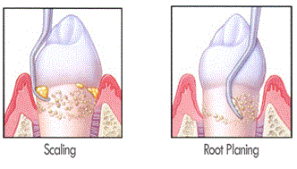 There are two types of cleaning; scaling and deep cleaning.&nbsp;