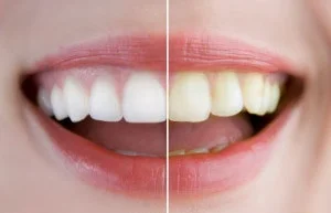 The results from a take home whitening kit will often make a noticeable change overnight.