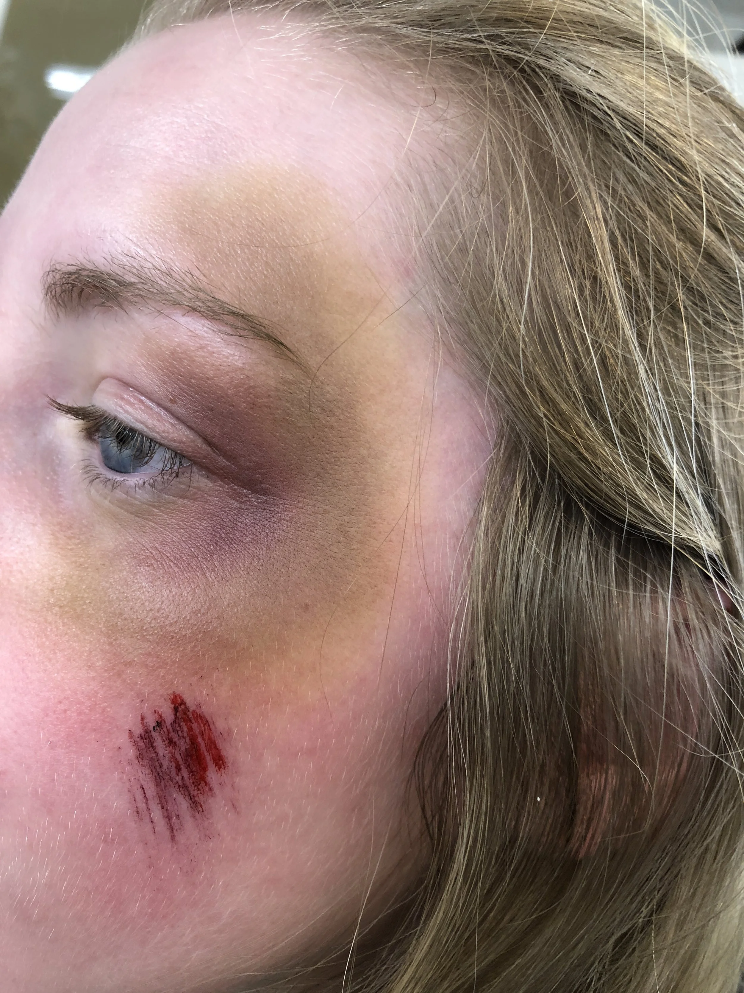 Old Bruising and Scrapes