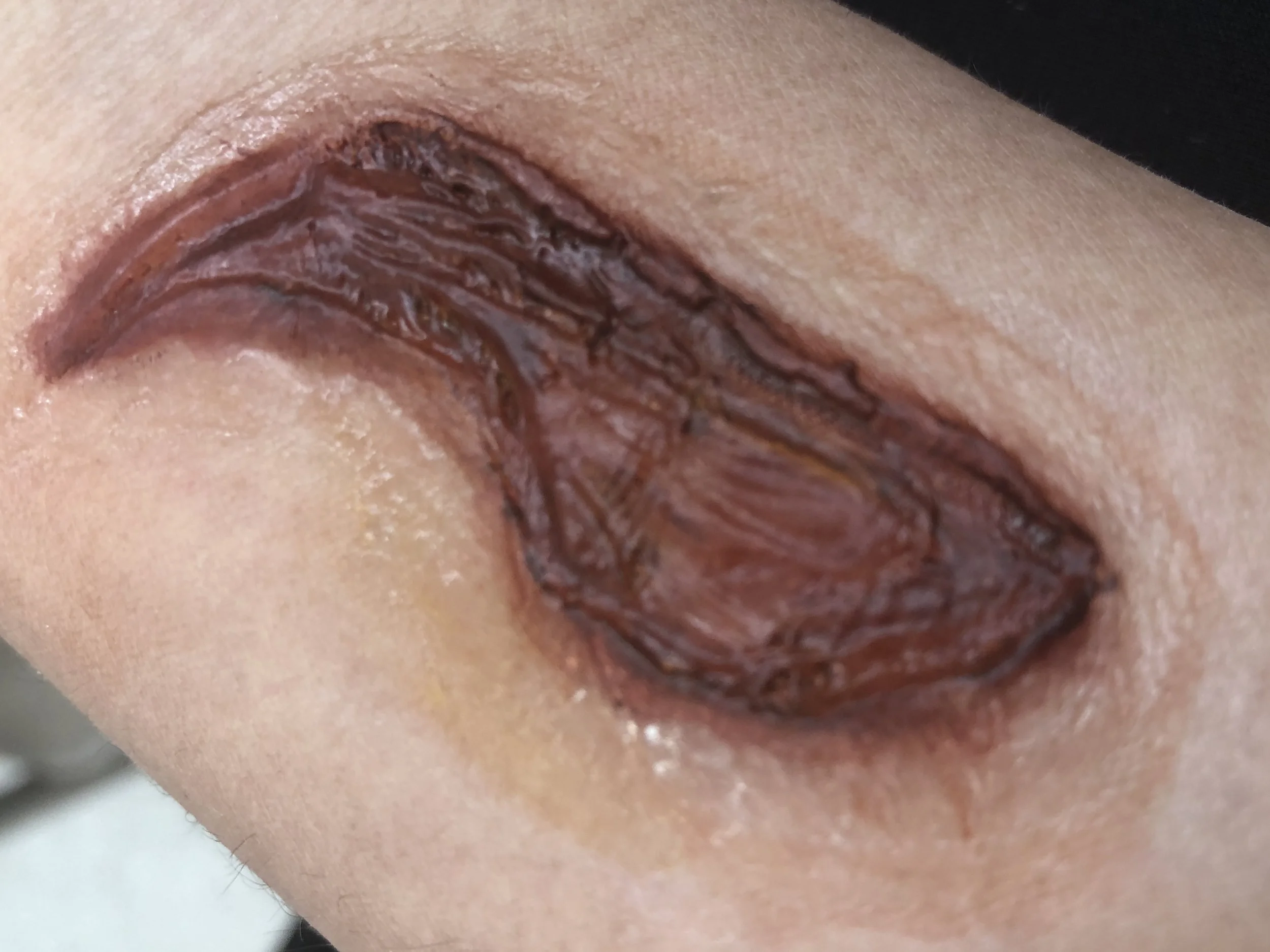 Pros-aide Transfer Injury Application