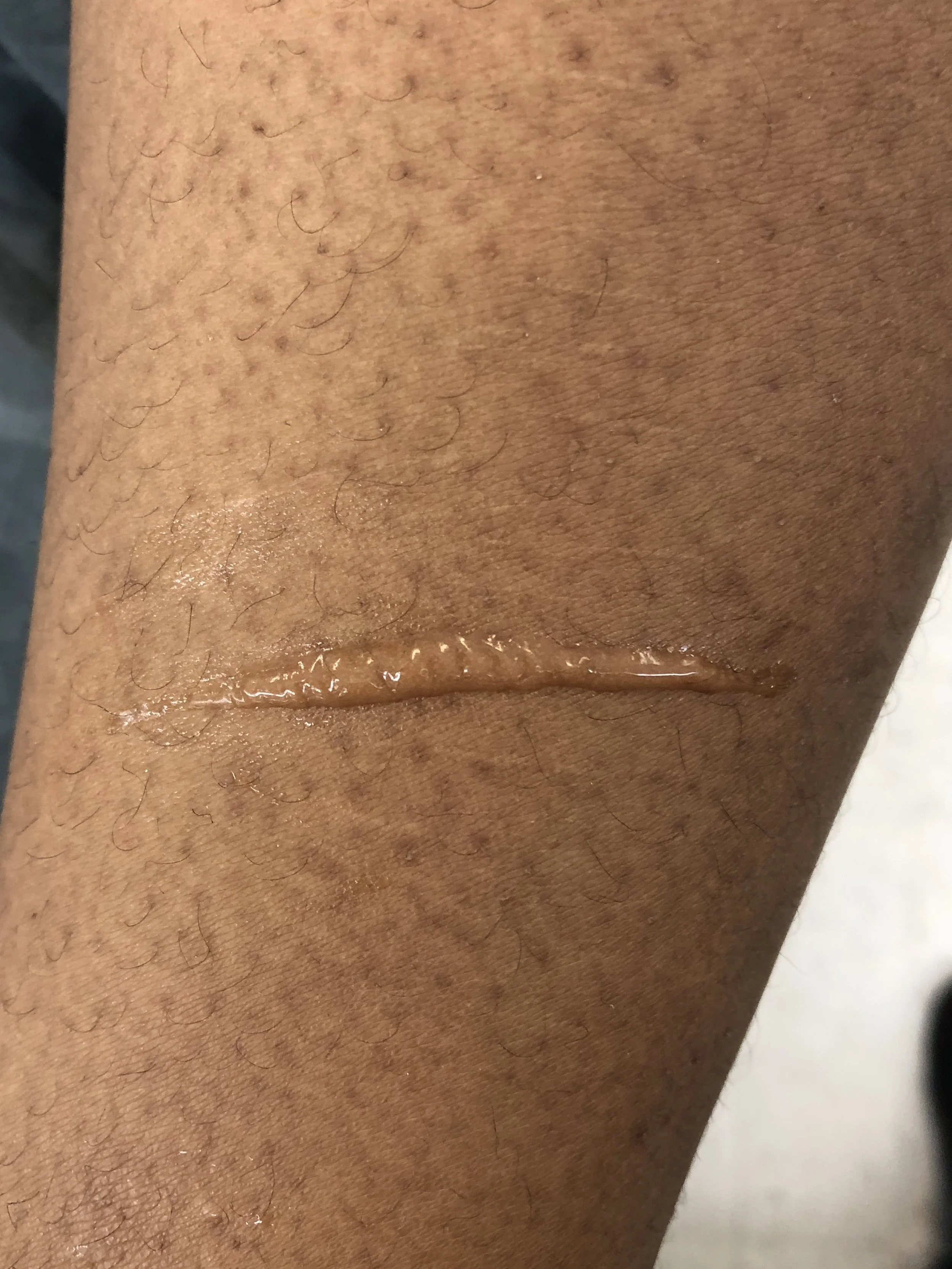 Keloid Scar