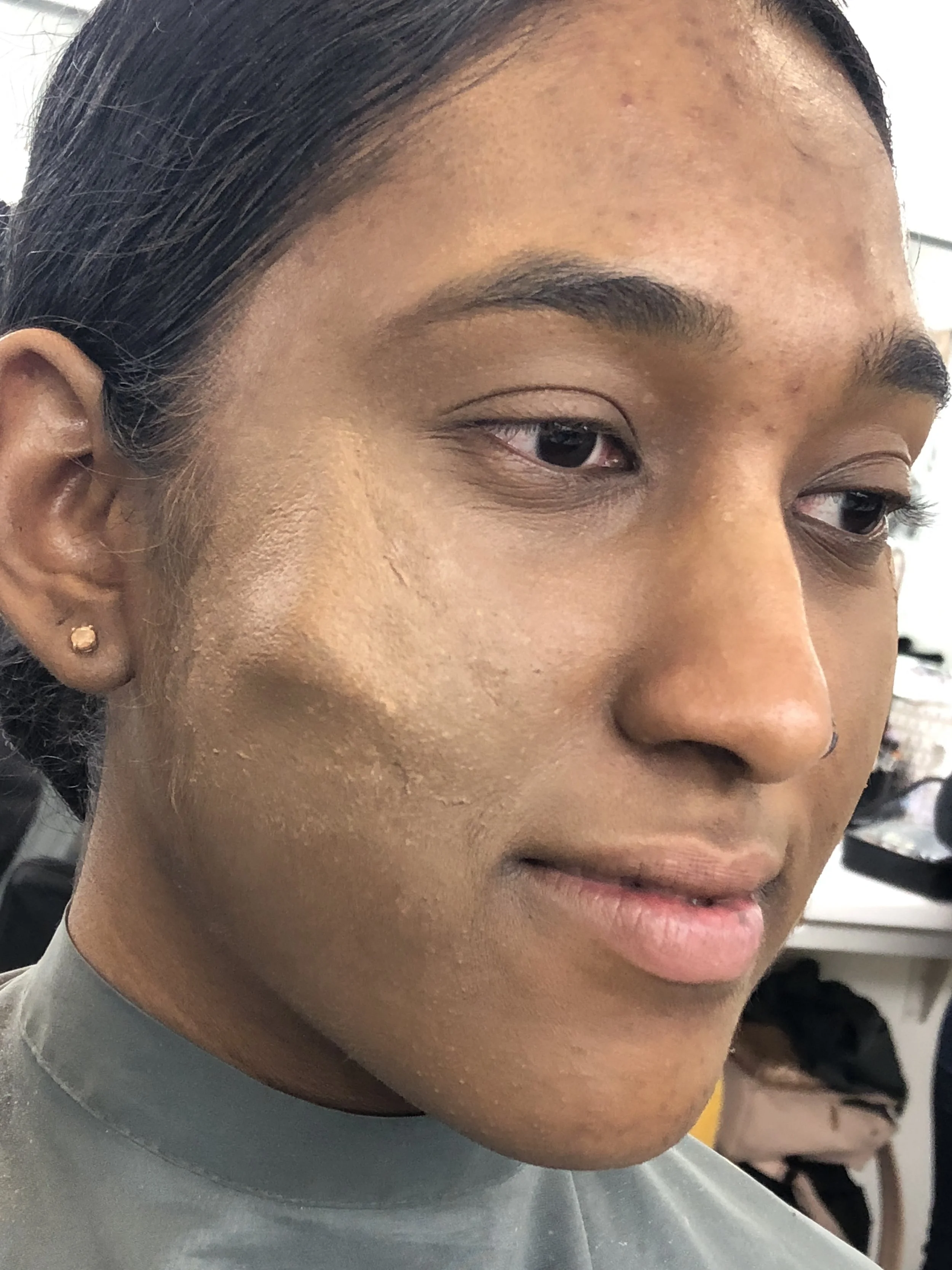 Cheek Prosthetic
