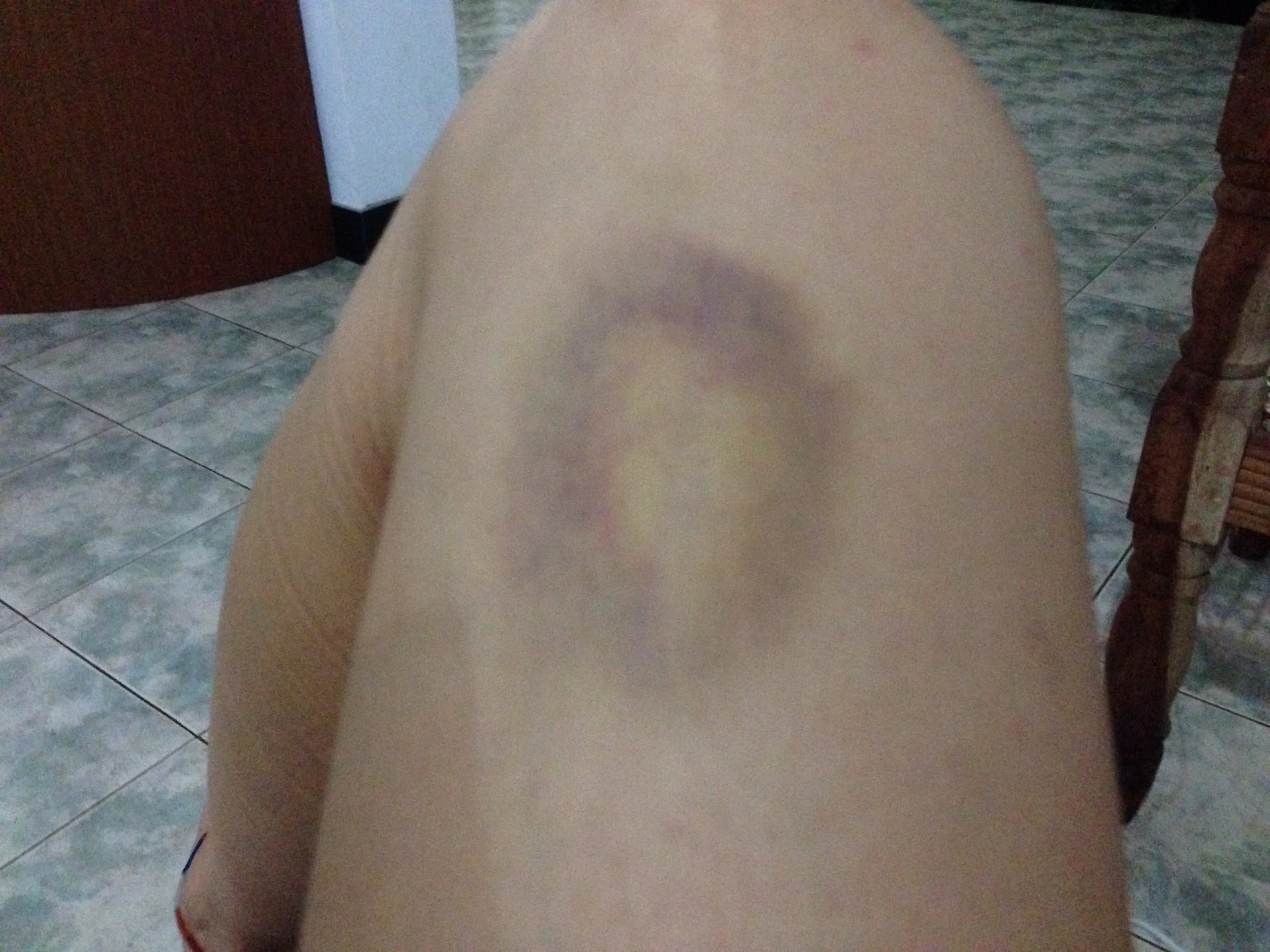 Mystery bruise