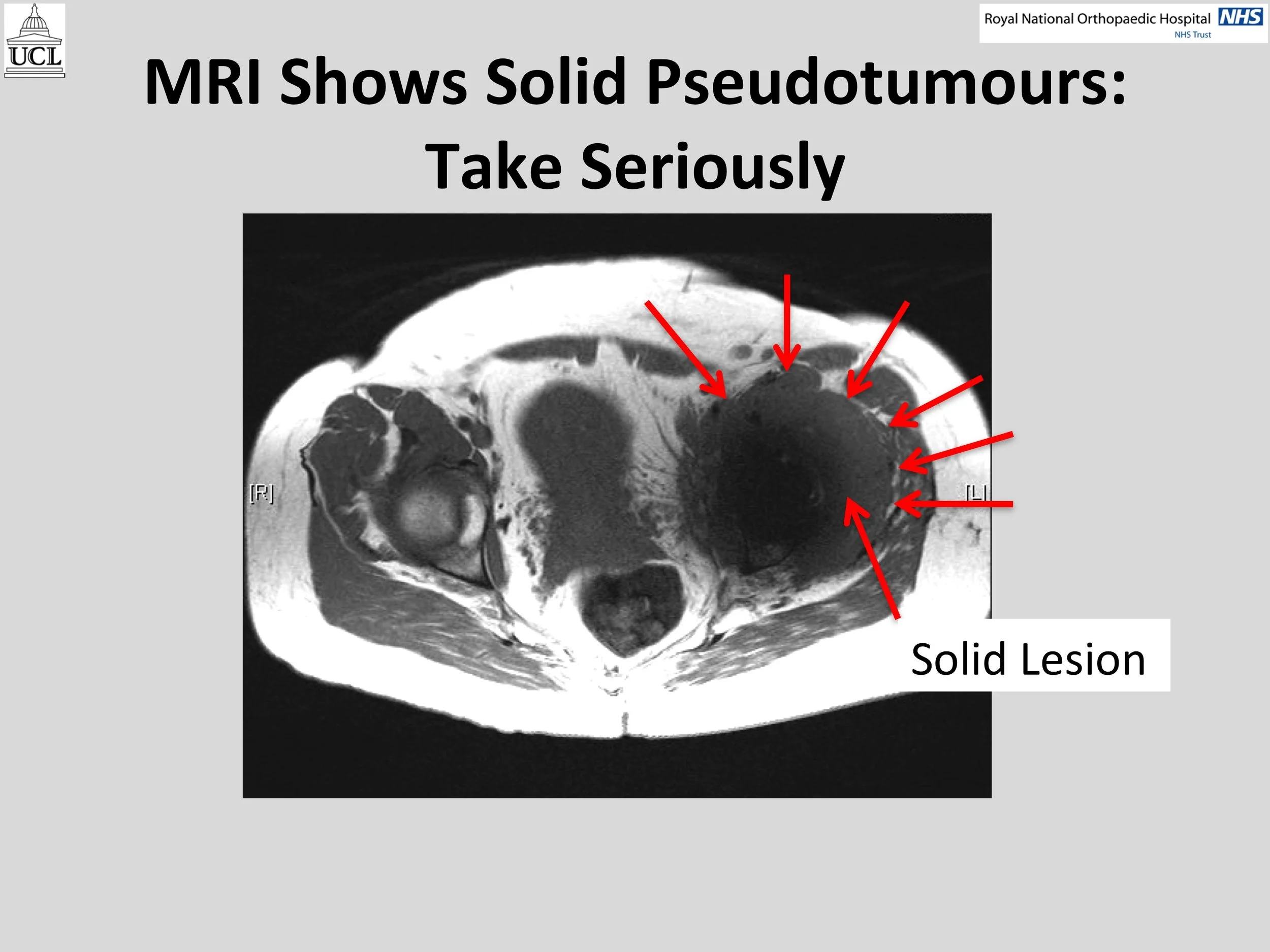 MOM Hip Info Slide11.jpg