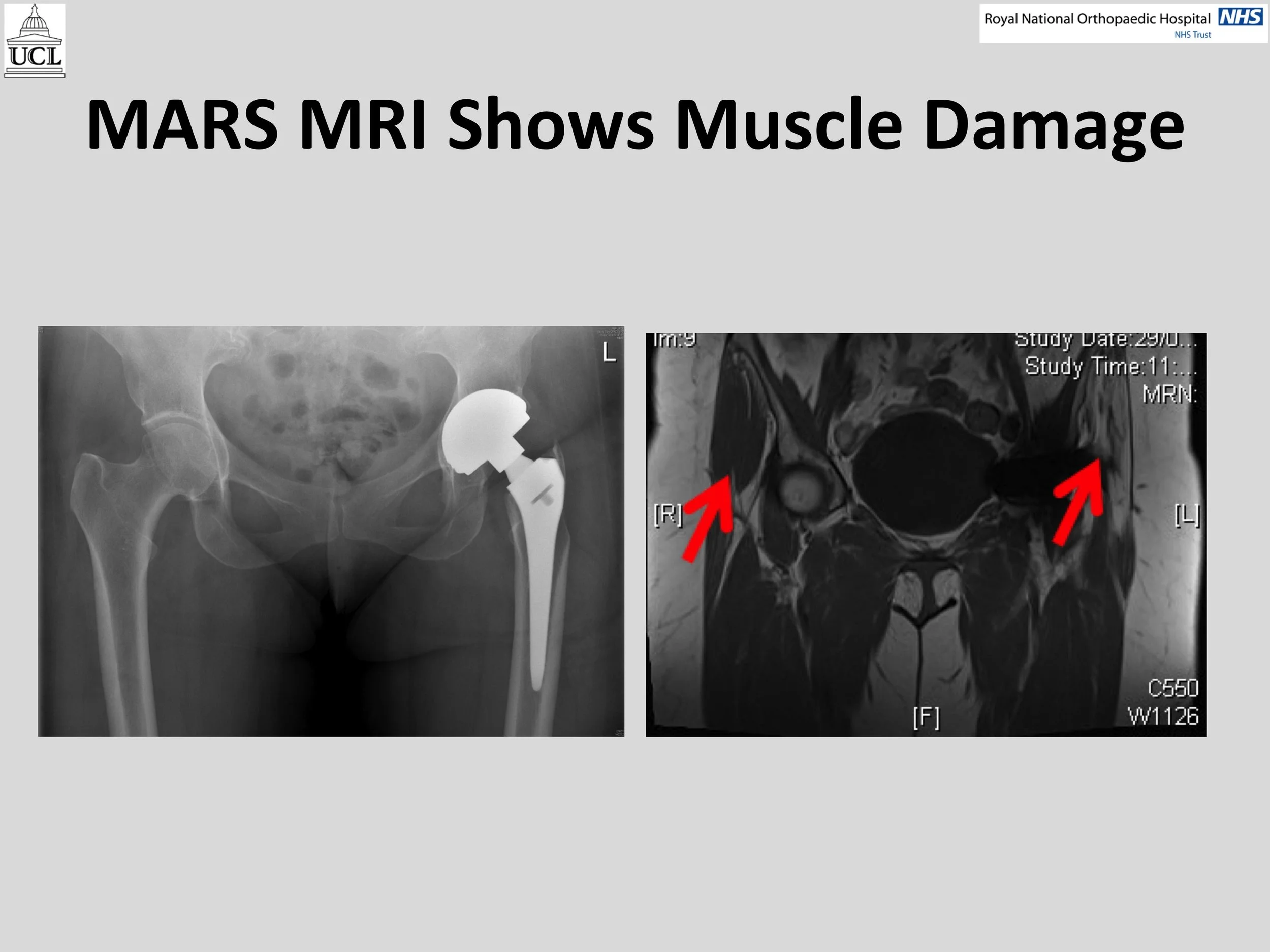 MOM Hip Info Slide12.jpg