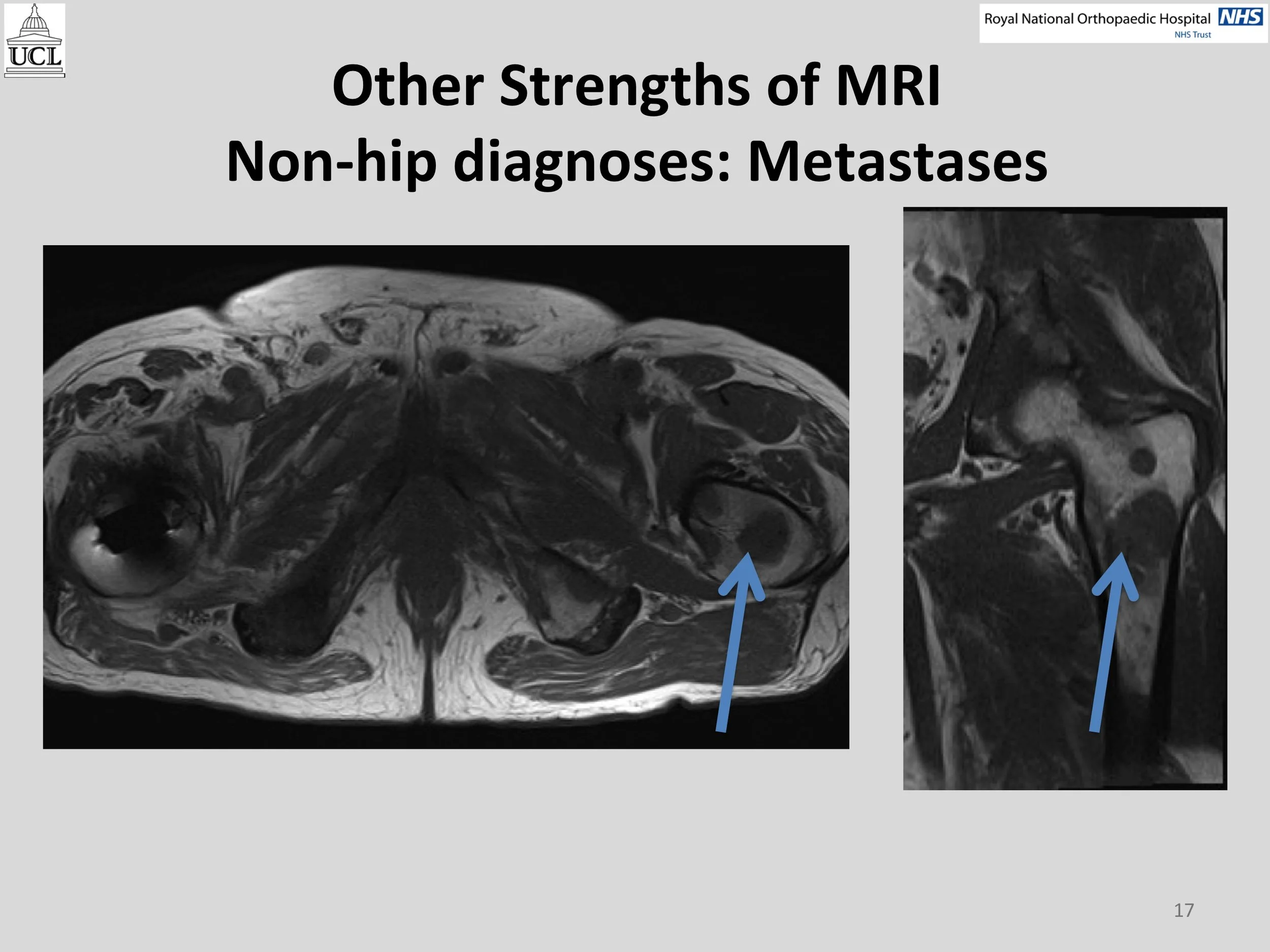 MOM Hip Info Slide17.jpg