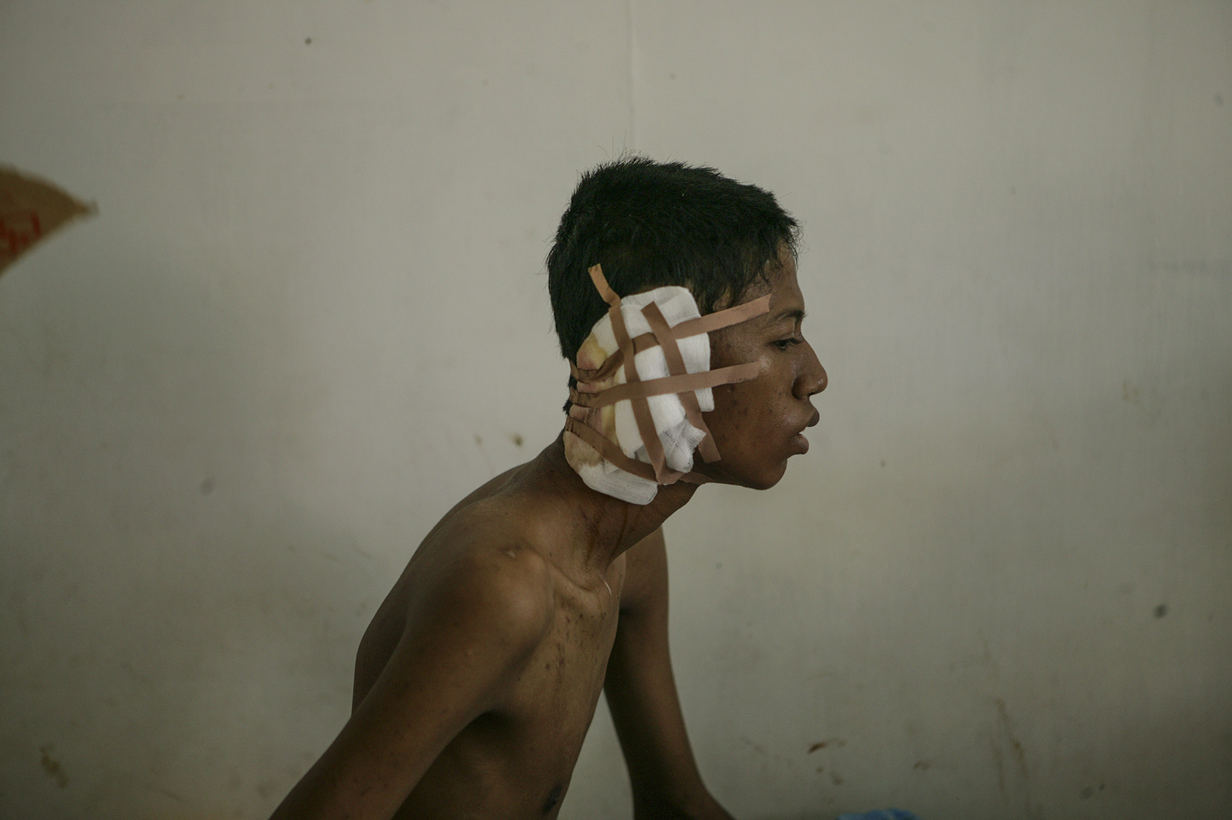  Hospitals were filled with wounded locals who fled to the hills during the tsunami and returned with severe infections. This young man lost an ear due to injuries he suffered during the tsunami.&nbsp; 
