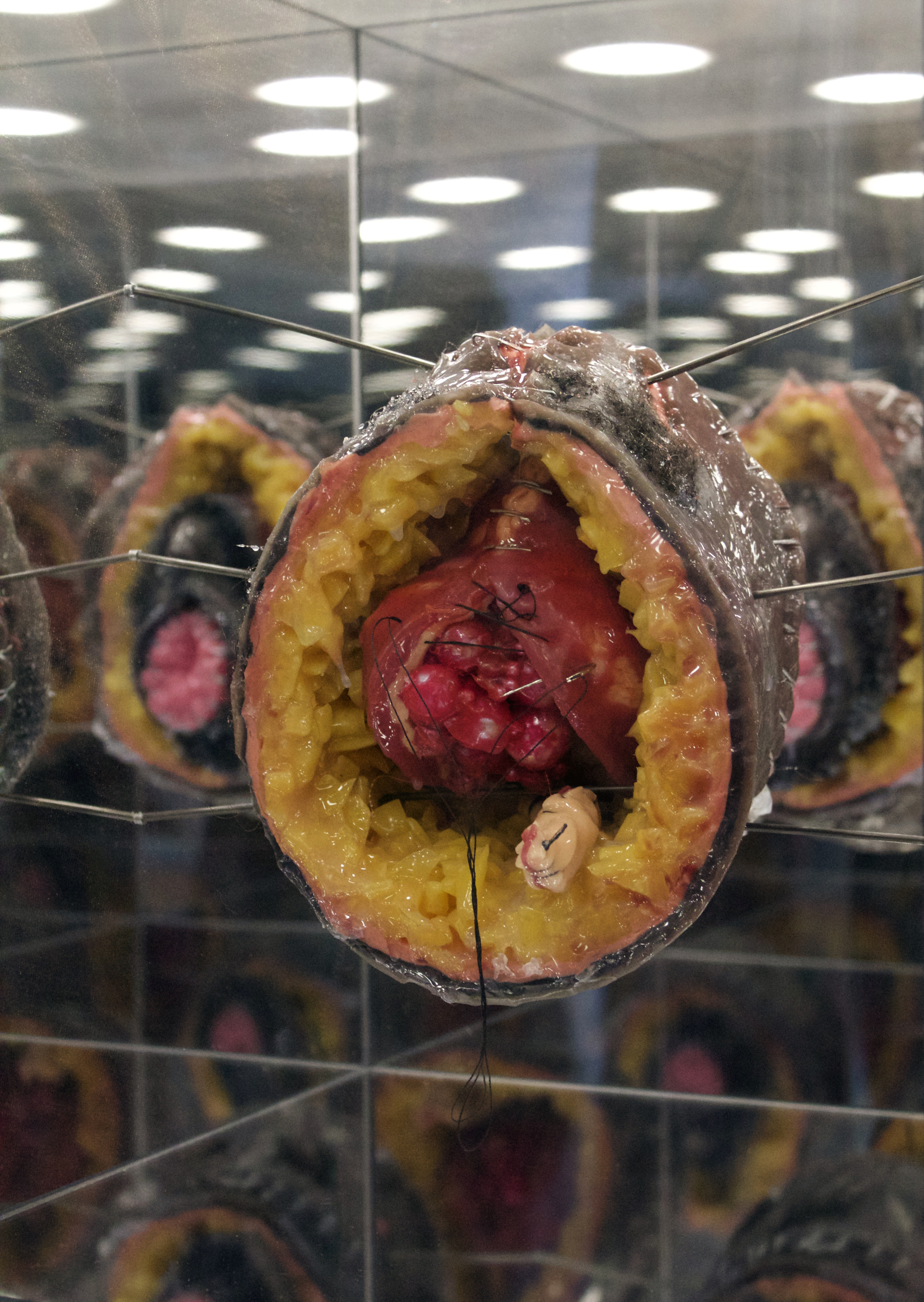 Vesico Vaginal Fistula (interior)