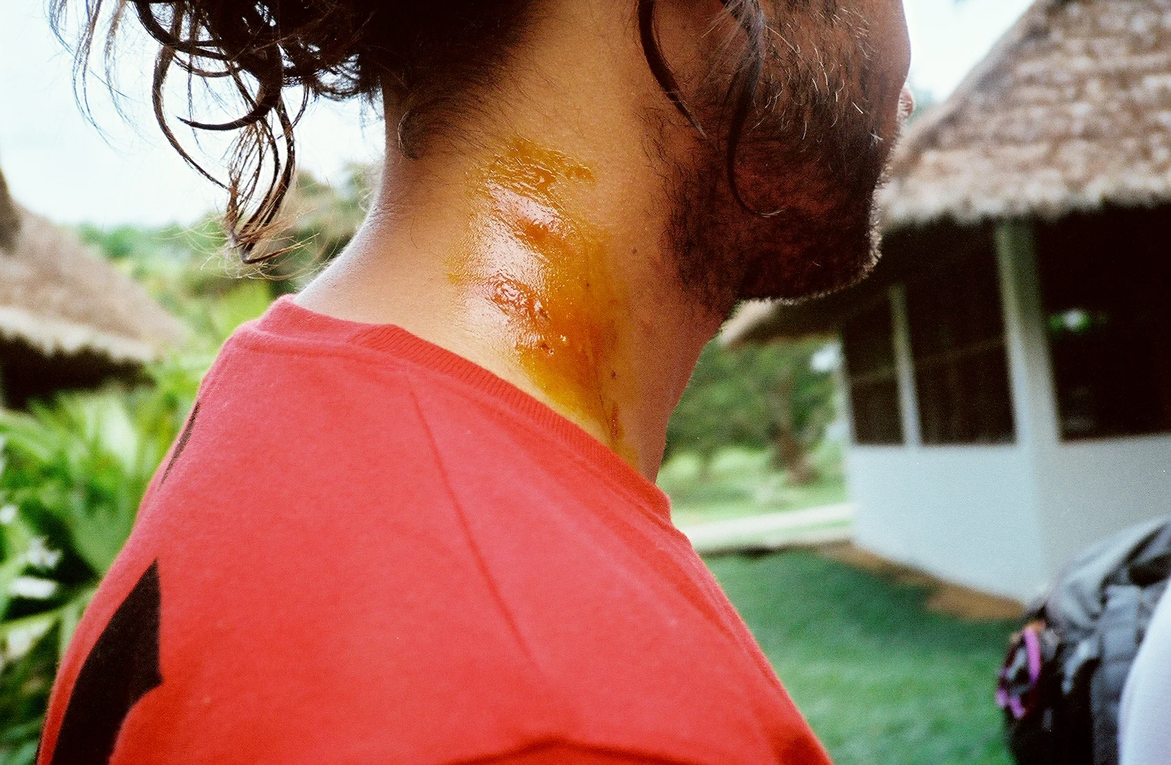 Spider Bite, Peruvian Amazon (2007)